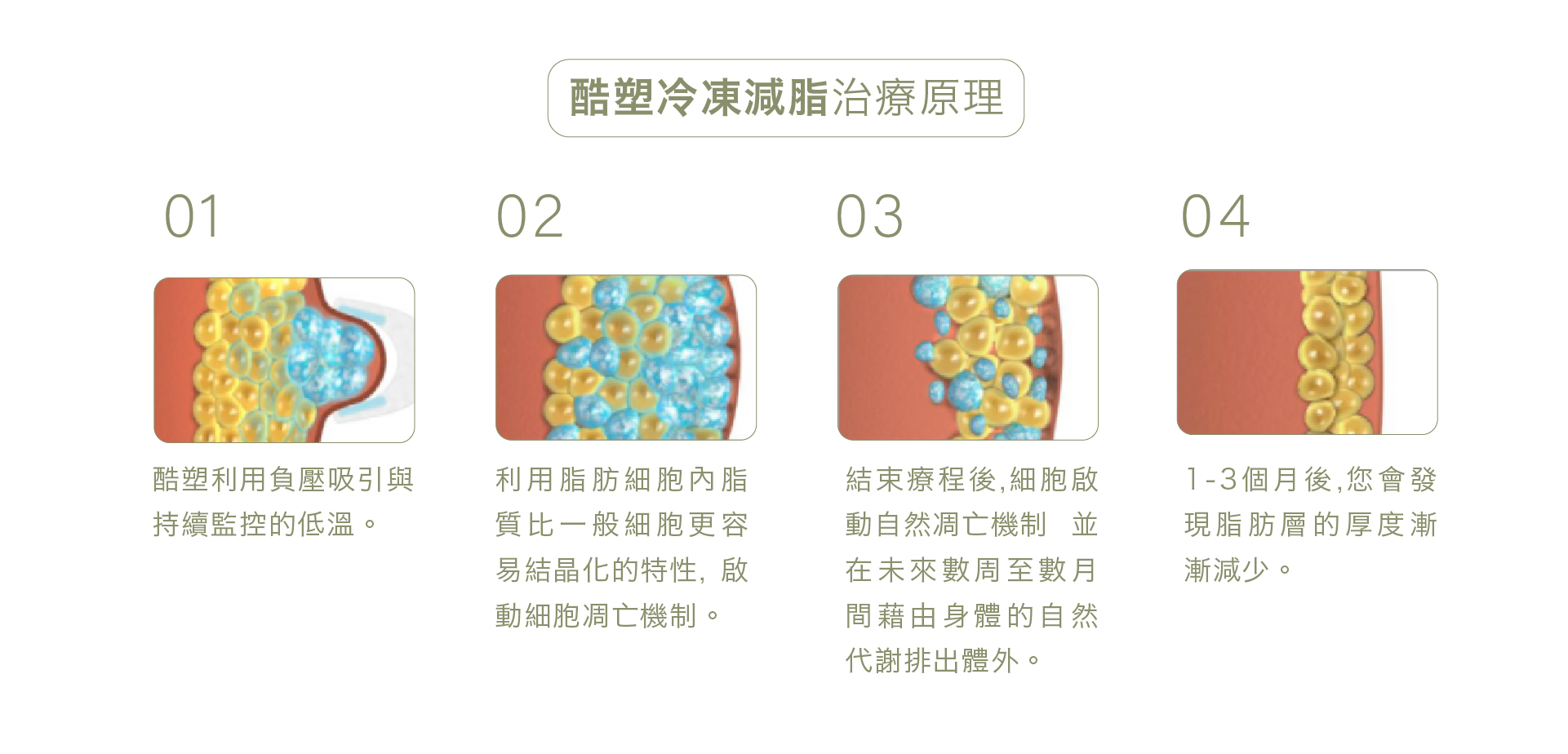 酷塑冷凍減脂治療原理