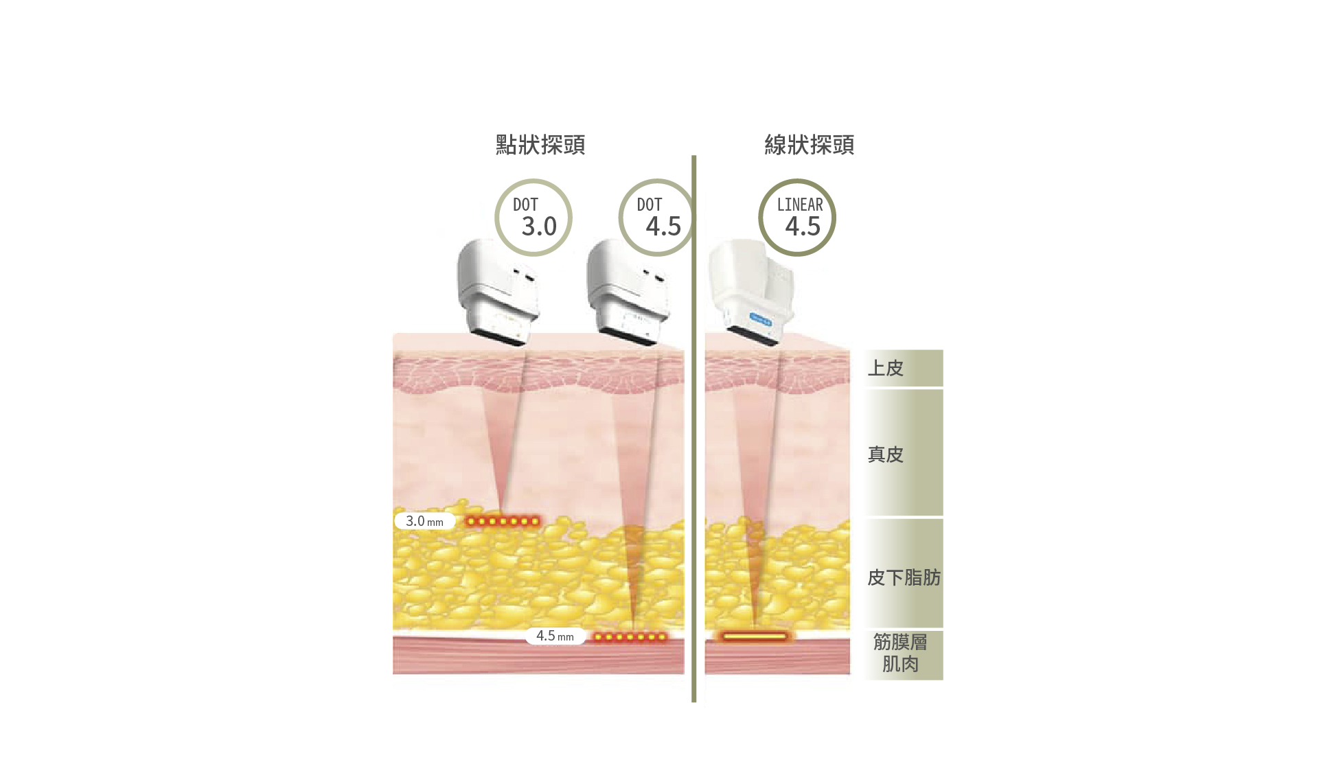 療程說明圖_Q+ 立線音波
