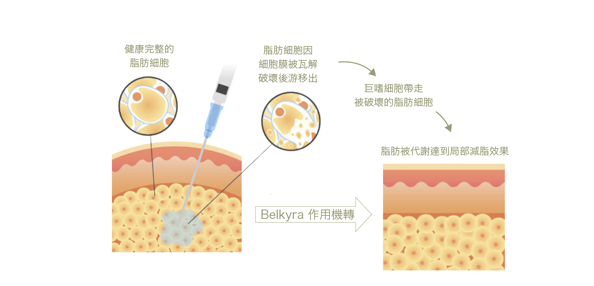 青春微整_倍克脂 _療程原理