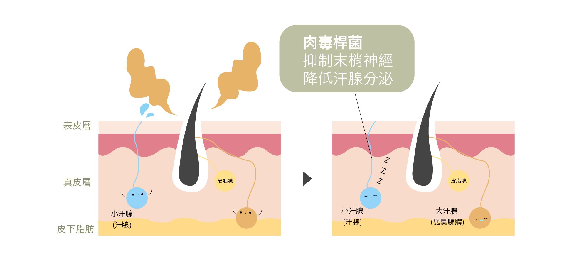 青春微整_多汗症治療原理