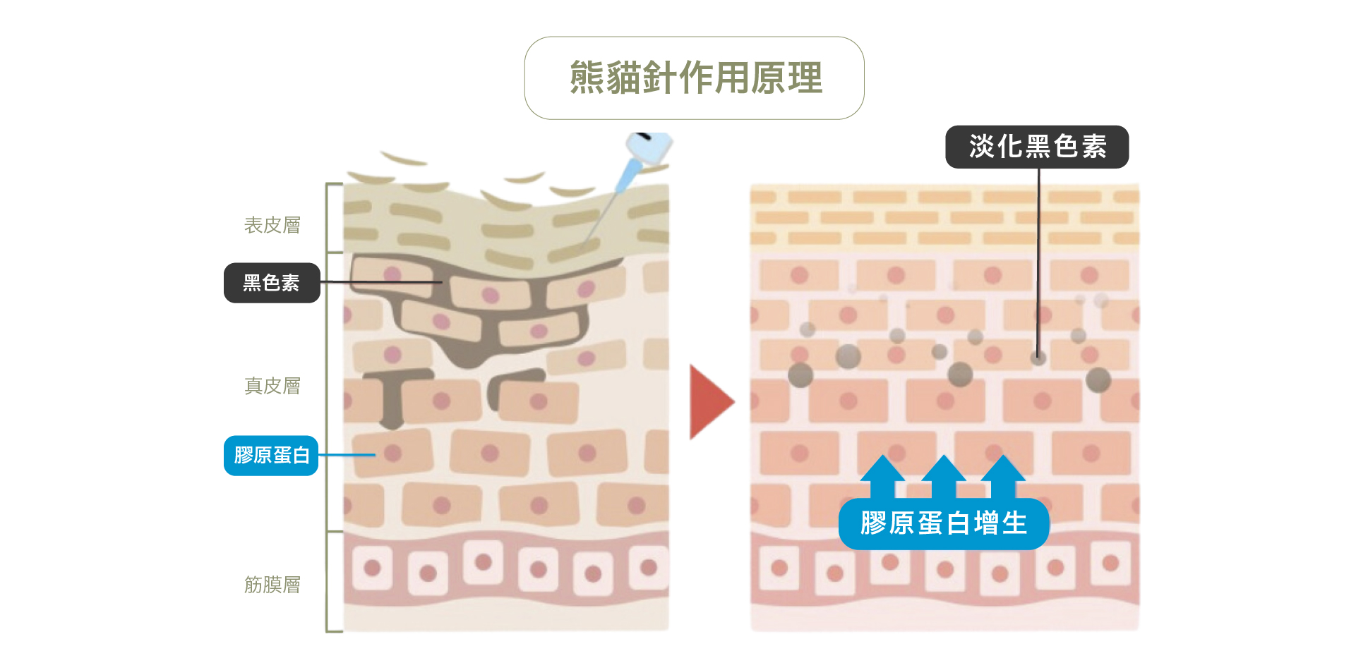 青春微整_熊貓針＿作用原理