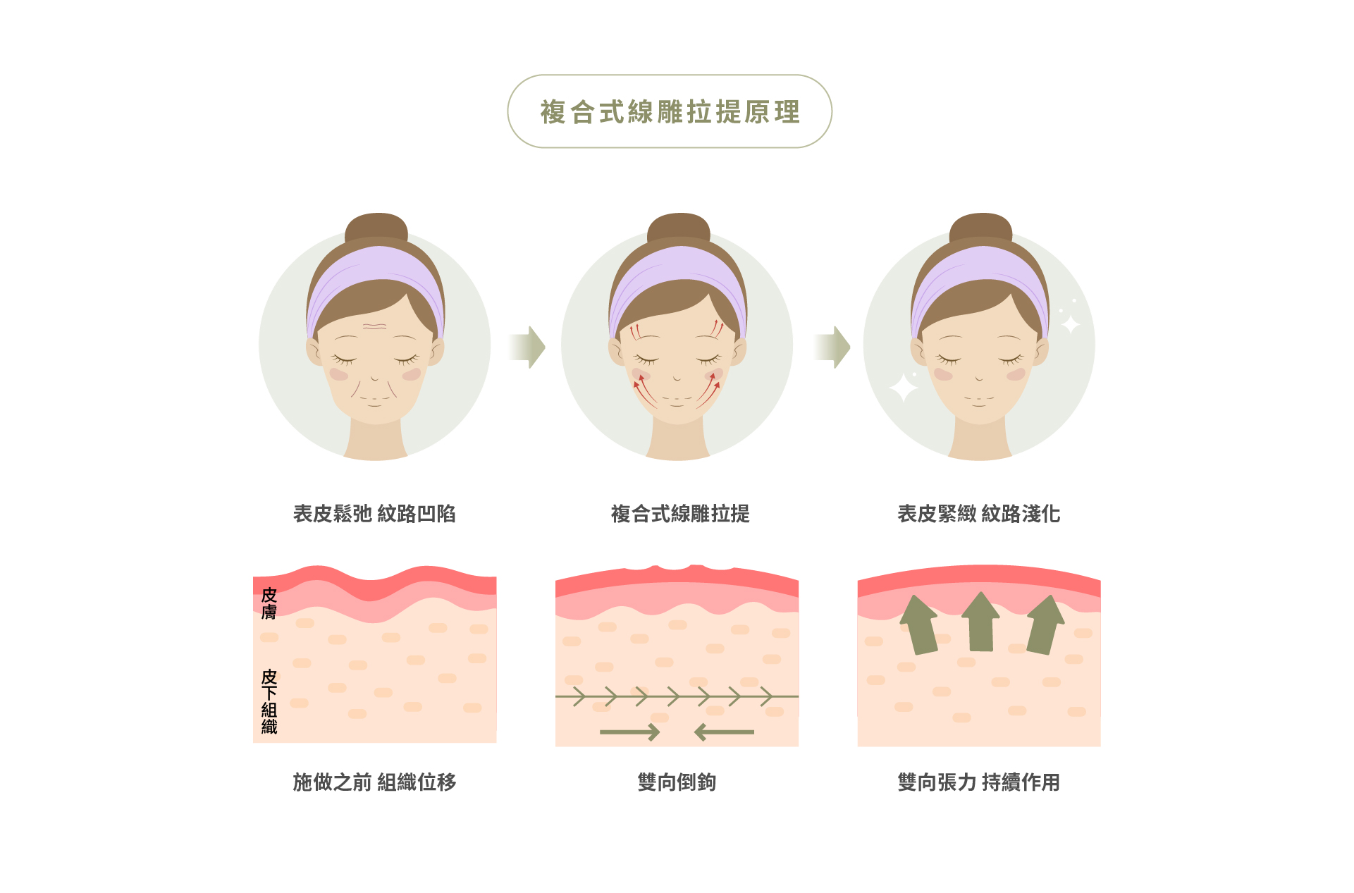 複合式線雕拉提原理