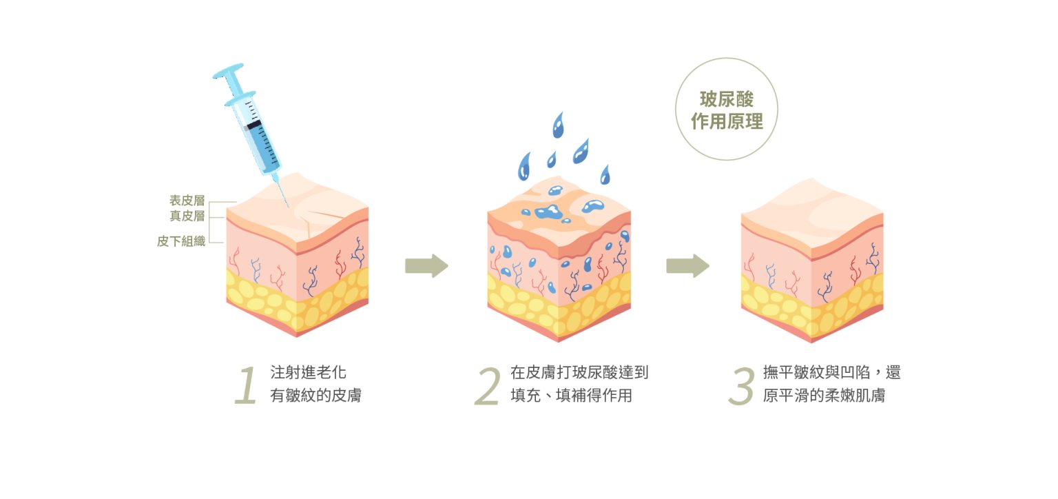 青春微整_玻尿酸_作用原理