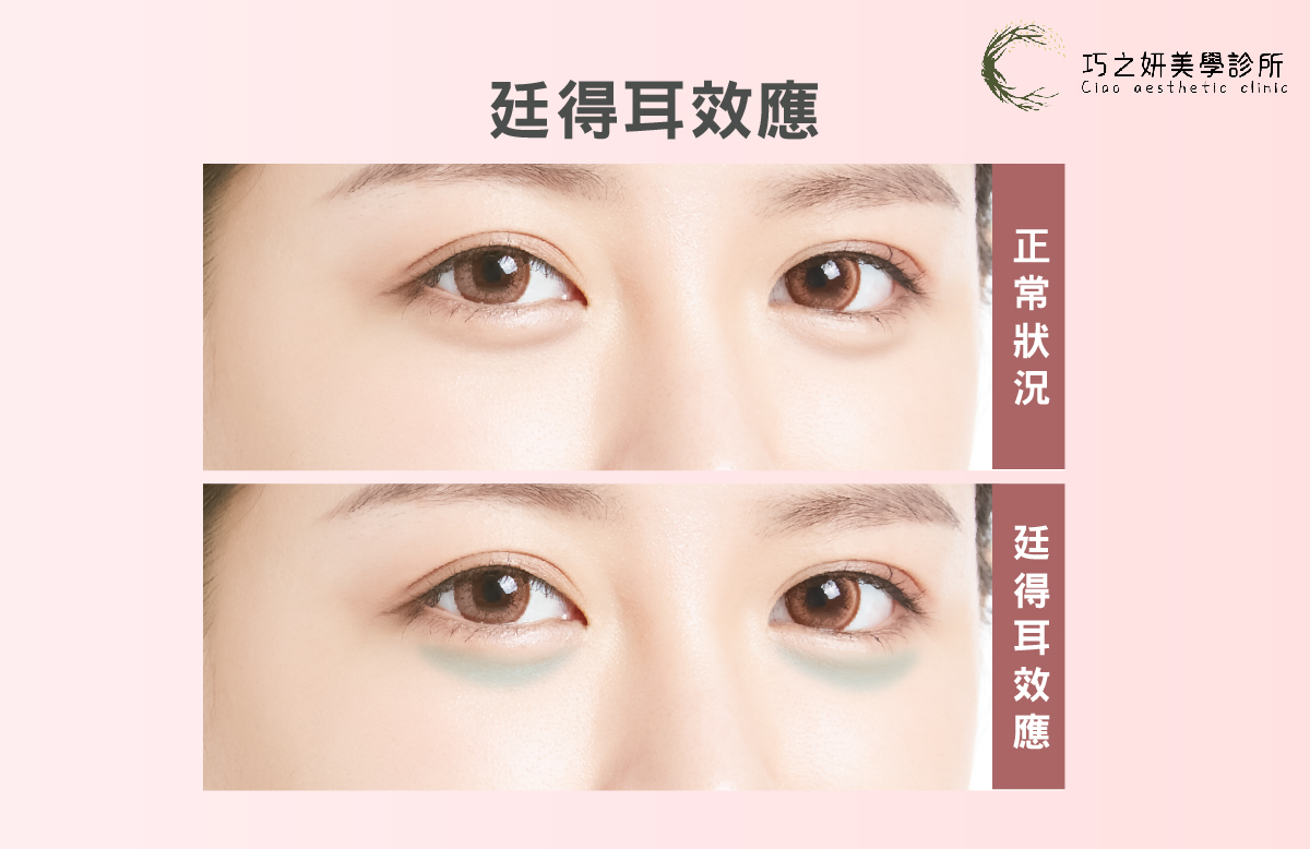 玻尿酸淚溝失敗情況1:廷得耳效應(Tyndall Effect)