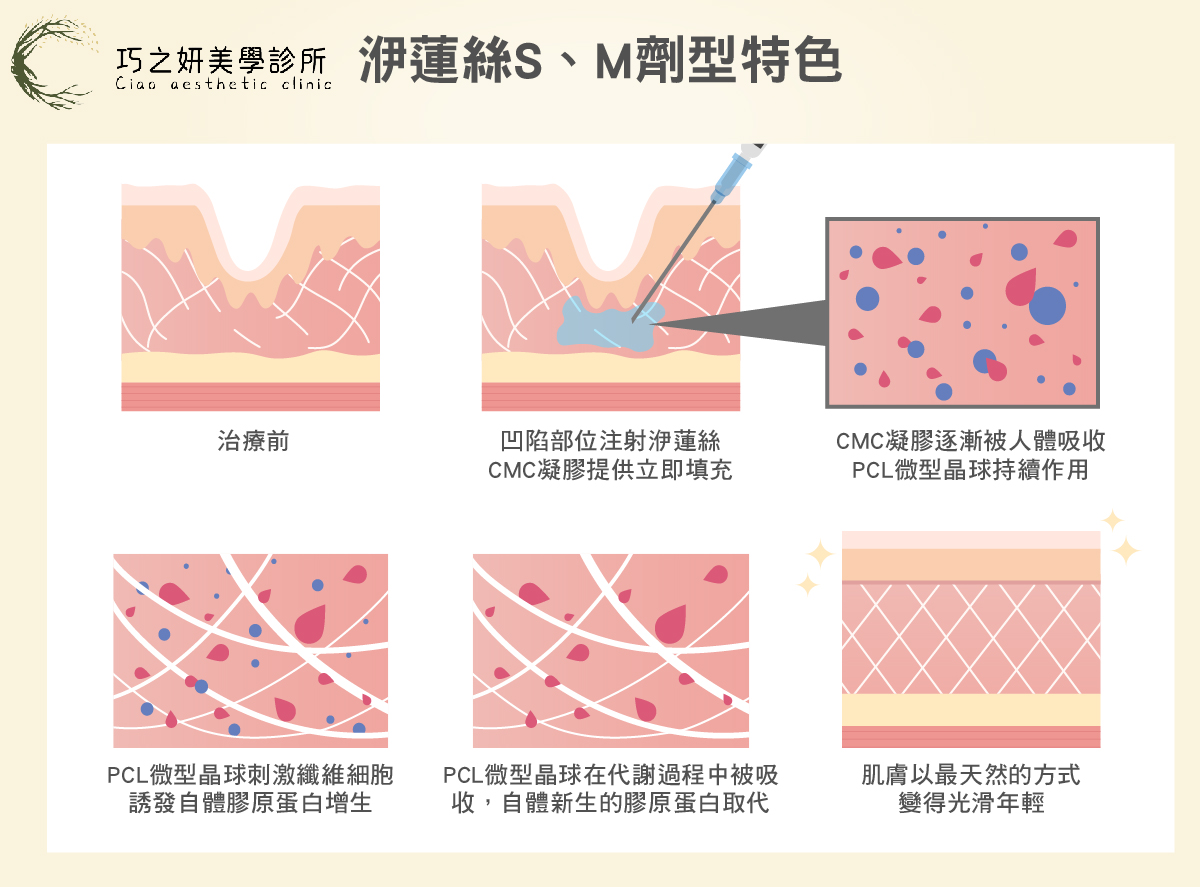 洢蓮絲—S、M劑型特色