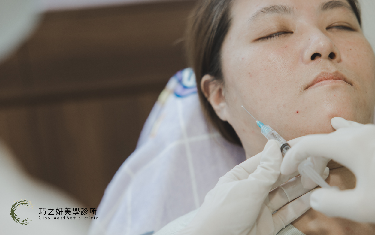 巧之妍-嘴邊肉治療膠原蛋白增生劑