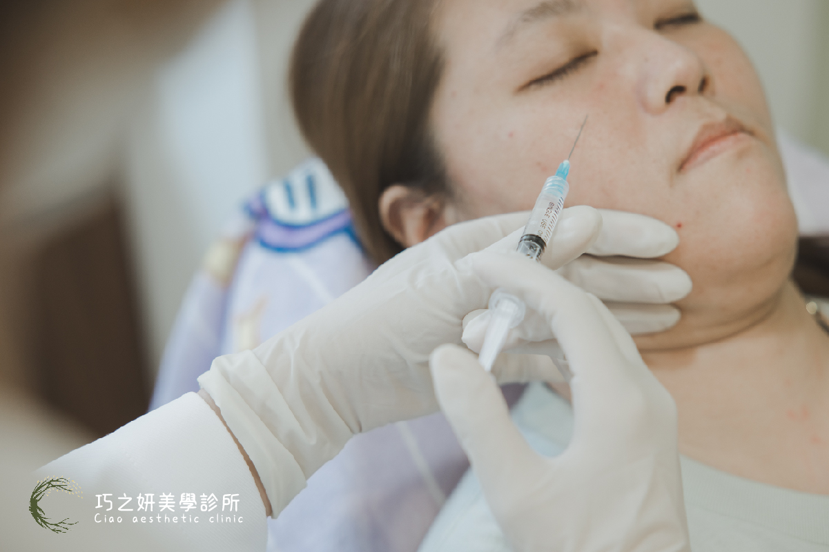 巧之研-治療淚溝怎麼選?玻尿酸 vs 膠原蛋白增生劑