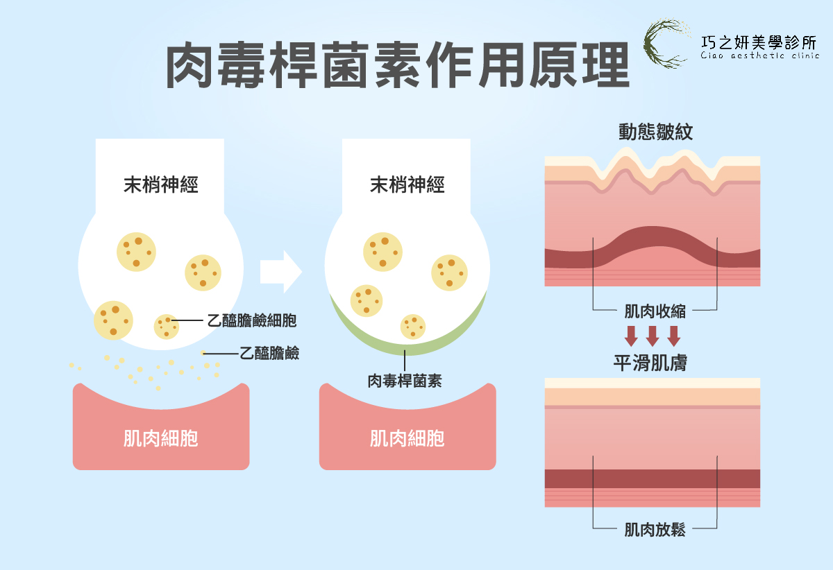 你可能聽過「肉毒桿菌素會麻痺肌肉」這種說法，但實際上，它只是暫時阻斷神經傳導訊號讓那些「太常收縮、太用力」的肌肉放鬆。