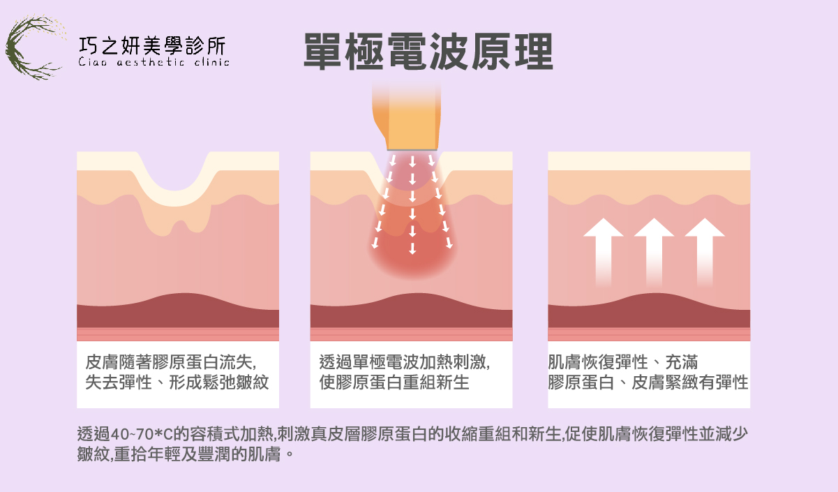 十蓓電波韓國原廠技術的研發初衷，是為了更貼近亞洲人的膚質特性。有別於傳統電波讓人卻步的強烈痛感，十蓓電波透過探頭與能量輸出的優化，讓「變美」的過程更加舒適，不再需要過度忍耐。 它採用的是高強度的「單極電波」技術。 
