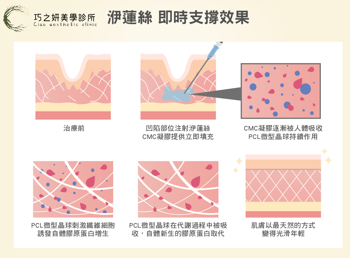 洢蓮絲（Ellanse） 關鍵成分：微型晶球（PCL）+ 凝膠載體（CMC）。 作用原理：因為含有凝膠載體，打下去的當下就有支撐效果（類似玻尿酸），後續晶球再持續刺激膠原新生。