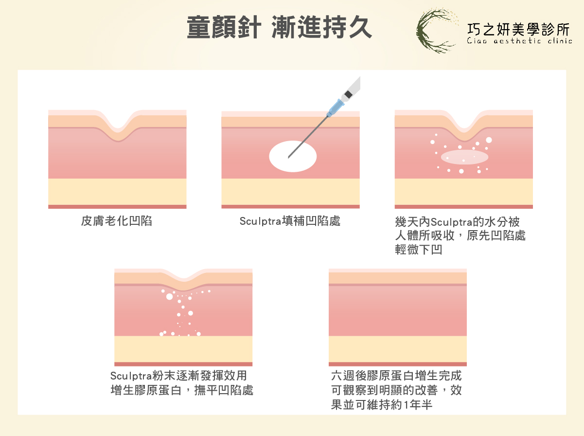 童妍針（Sculptra） 關鍵成分：聚左旋乳酸（PLLA）。 作用原理：。剛打完時只有水分撐起，幾天後水分吸收會恢復原狀，接著在 1-3 個月內，誘導膠原蛋白新生。