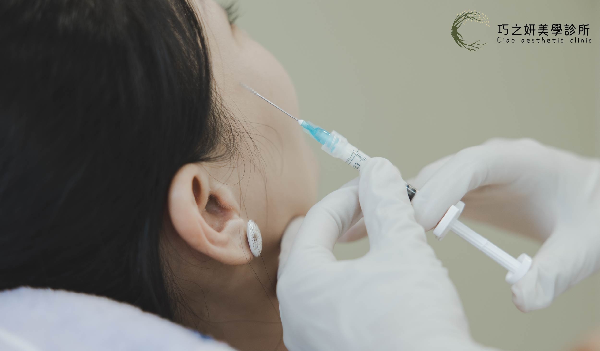 巧之妍運用「膠原蛋白增生劑」（如4D童妍針、洢蓮絲），誘導自體膠原蛋白新生。這不是單純的填充，而是重建肌膚內部的「鋼筋結構」，讓臉龐恢復自然的圓潤與彈性，擺脫苦命的疲憊感。