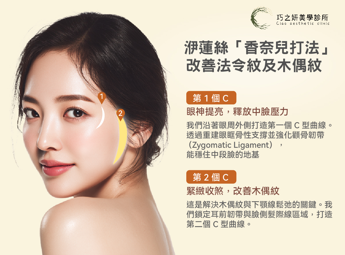 許多人來到診間，劈頭就問：「醫生，幫我把法令紋填平！」 但我們常提醒，法令紋與木偶紋往往是中臉下垂的「結果」，而非「原因」。若只是一味地把紋路填滿，臉容易看起來腫脹不自然。 在巧之妍，我們不建議單純填補凹陷，而是採用進階的「 香奈兒打法」。利用洢蓮絲強大的支撐力與膠原新生特性，針對臉部韌帶進行結構性的隱形拉提，再配合下巴的精雕，完成全臉的比例平衡。 巧之妍「香奈兒打法」，像綁高馬尾般的隱形拉提