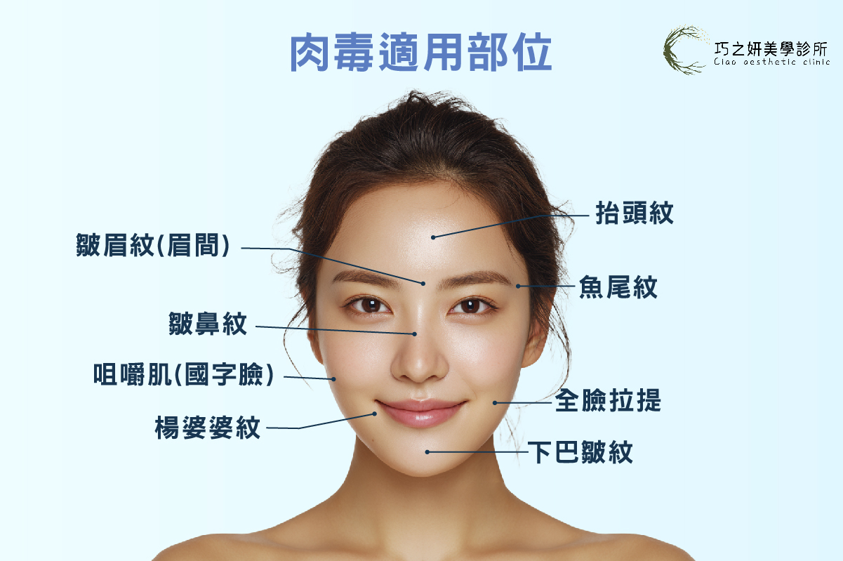 了解肉毒劑量與打肉毒位置：讓五線譜額頭漸漸消失 