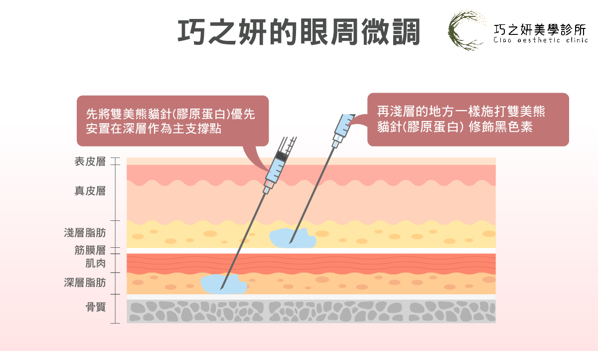 巧之妍的「眼周微調」思維 