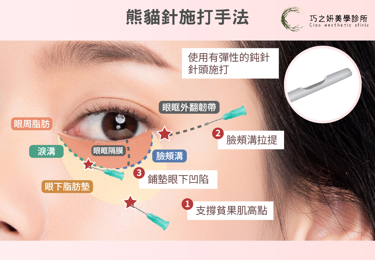 填充物不慎被打入動脈，並隨著高壓逆流至眼動脈系統，導致血管阻塞。