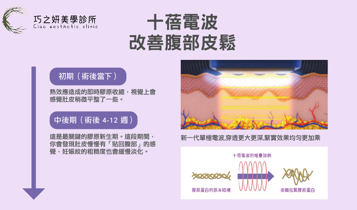 對於合併妊娠紋的腹部，我們會特別在紋路集中的區域施打4D童妍針。先藉由熱能刺激膠原與彈力纖維重塑，再利用4D童妍針誘導膠原蛋白增生的效果，能使紋路的凹陷感與顏色對比逐步減輕，讓皮膚的質地變得更加平滑。
