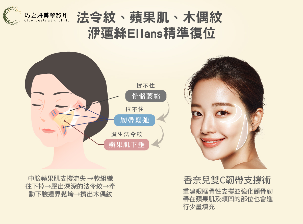 法令紋、蘋果肌、木偶紋 洢蓮絲Ellansé精準復位
