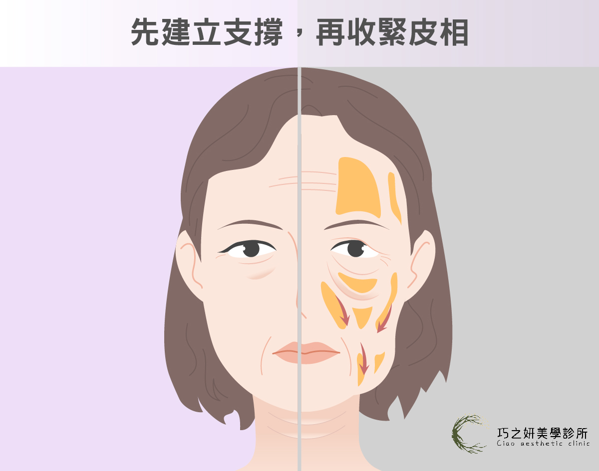 先建立支撐，再收緊皮相