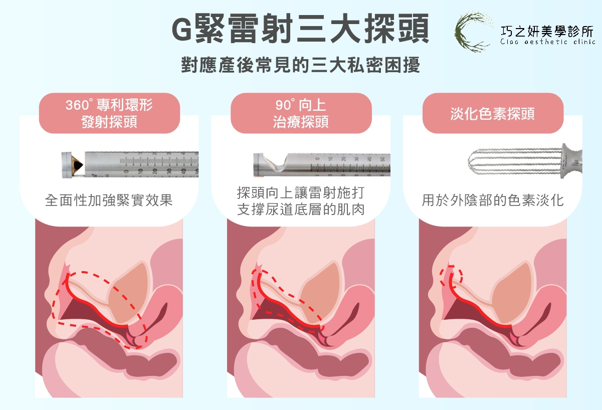 G緊雷射三種探頭，對應產後常見的三大私密困擾