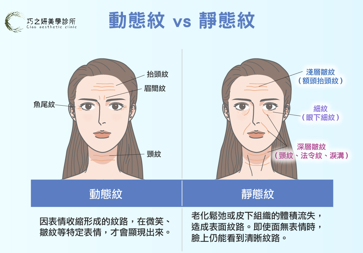 動態紋 vs 靜態紋