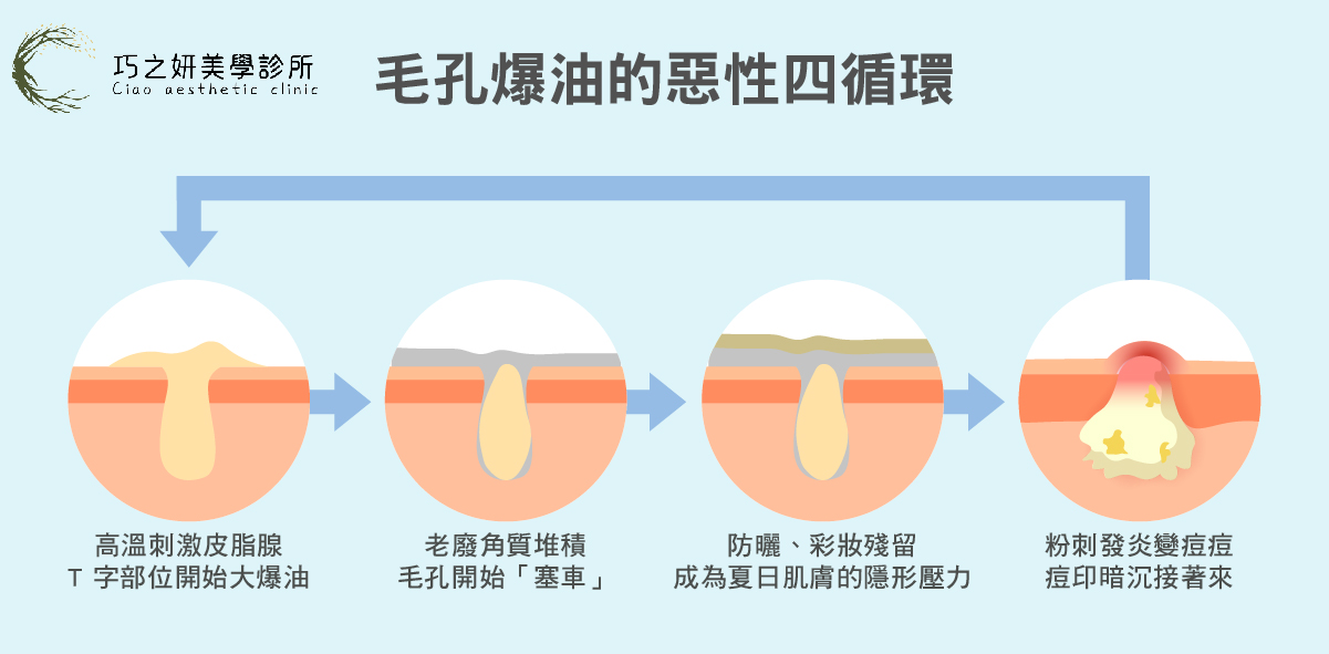毛孔爆油的惡性循環
