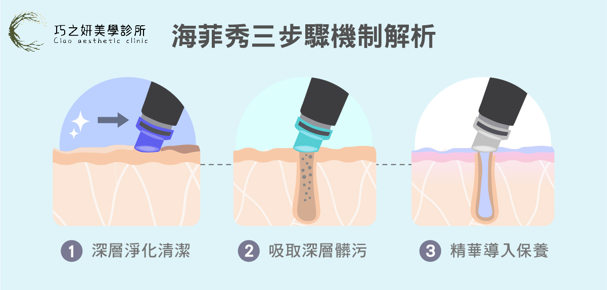 海菲秀三步驟機制解析