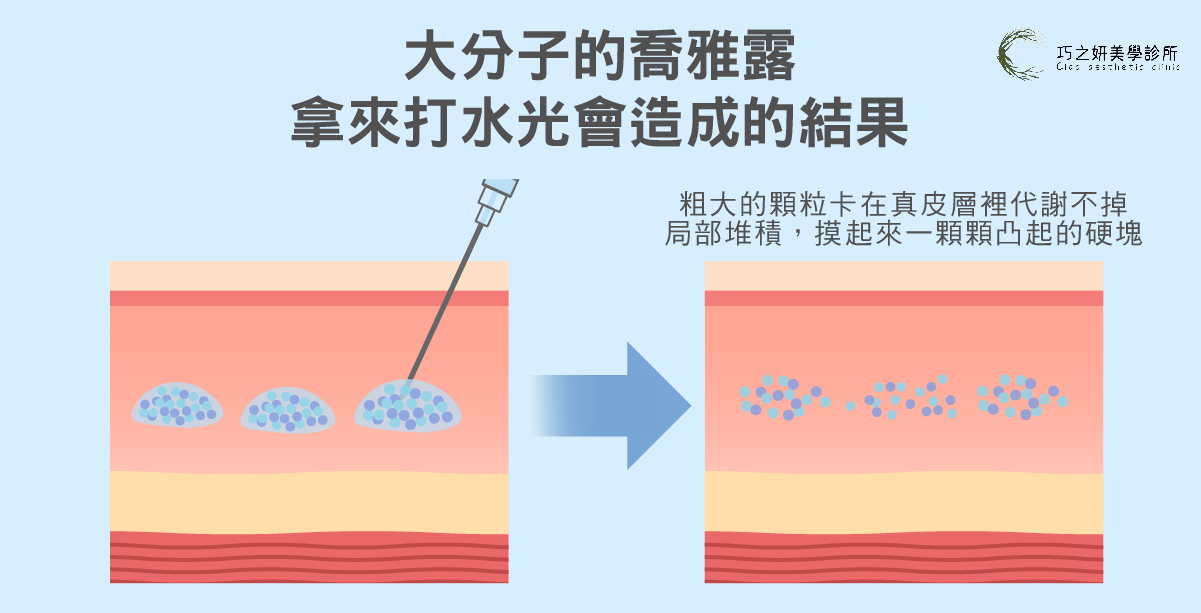 拿喬雅露大分子劑型打水光,會導致肌膚表層產生結節