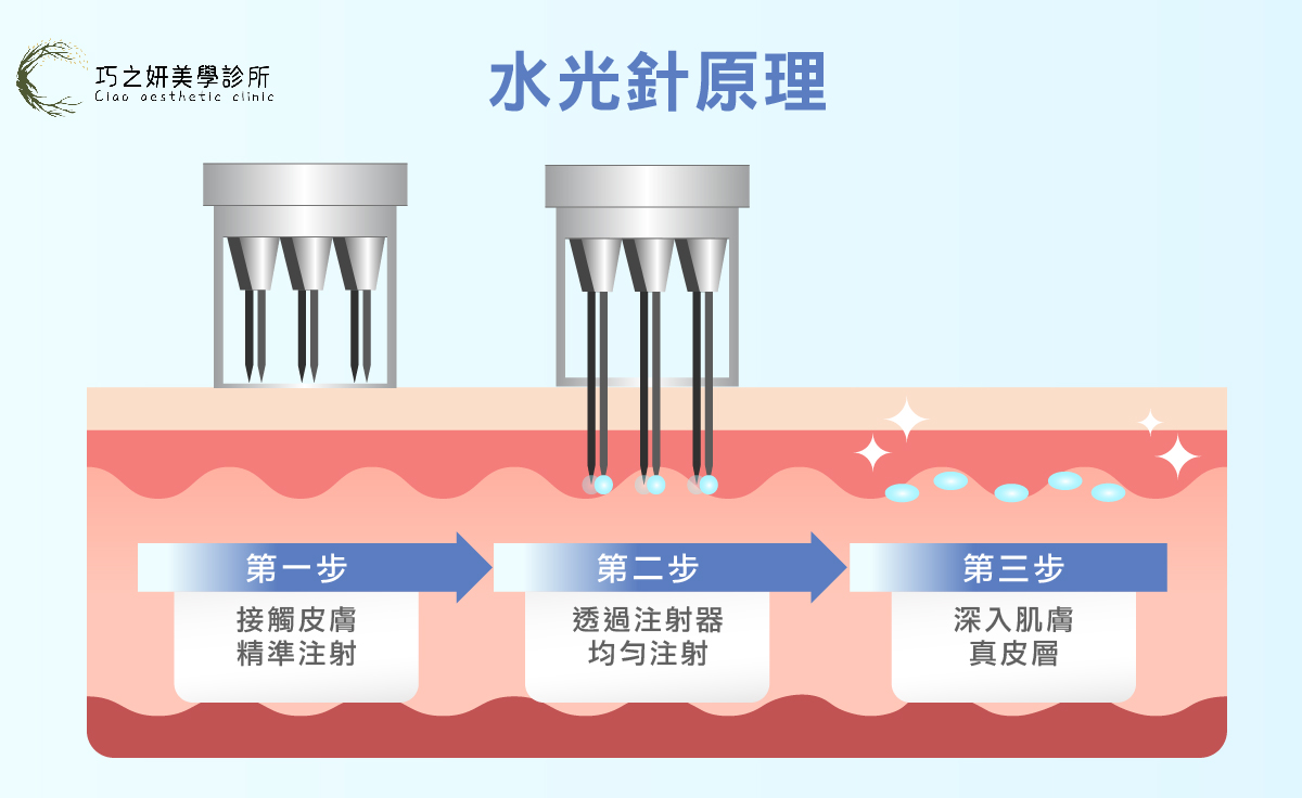 水光針原理