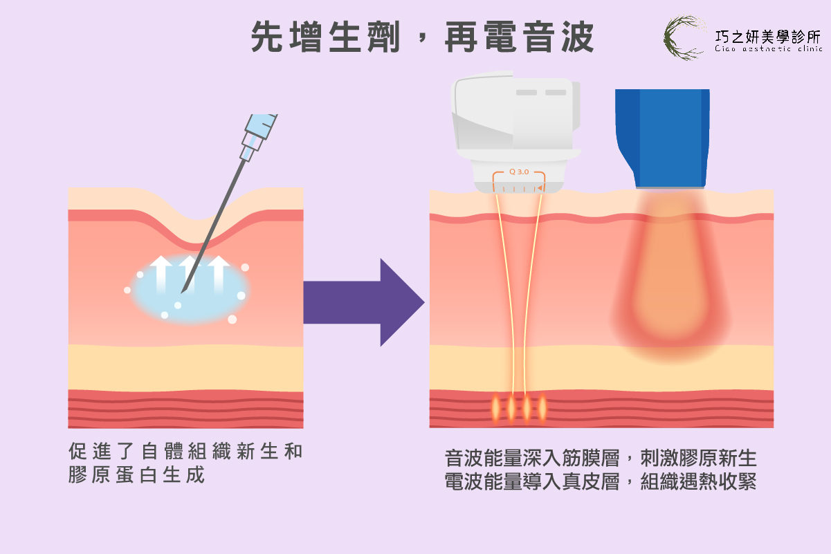 打膠原蛋白增生劑 先增生劑，再電音波 