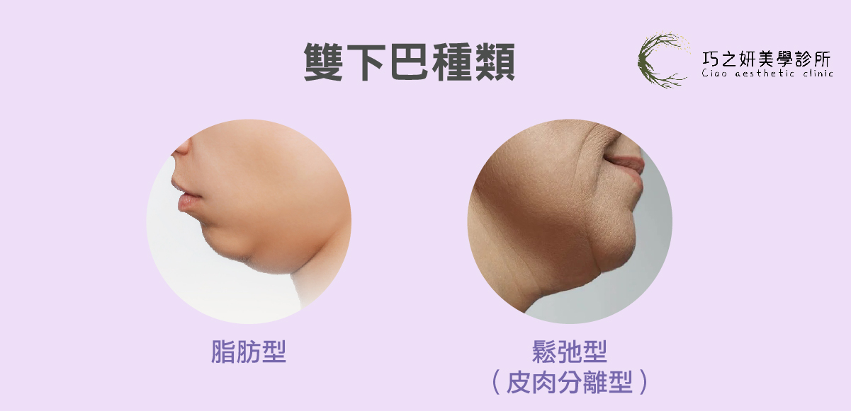雙下巴種類